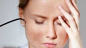 Cách cải thiện da nám