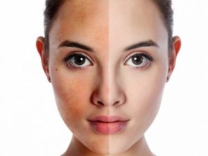 Cải thiện nám da