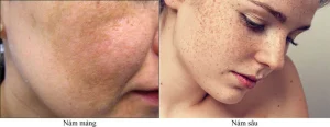 chăm sóc da nám