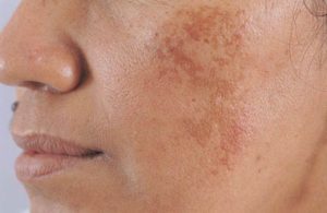 Liệu trình nờ nám