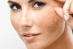 Giải pháp cải thiện nám