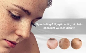 chăm sóc da sạm nám