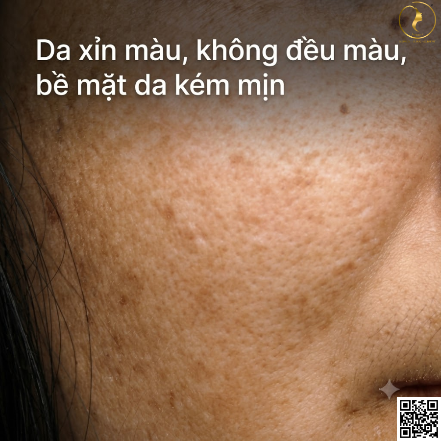 Da xỉn màu, không đều màu, bề mặt da kém mịn