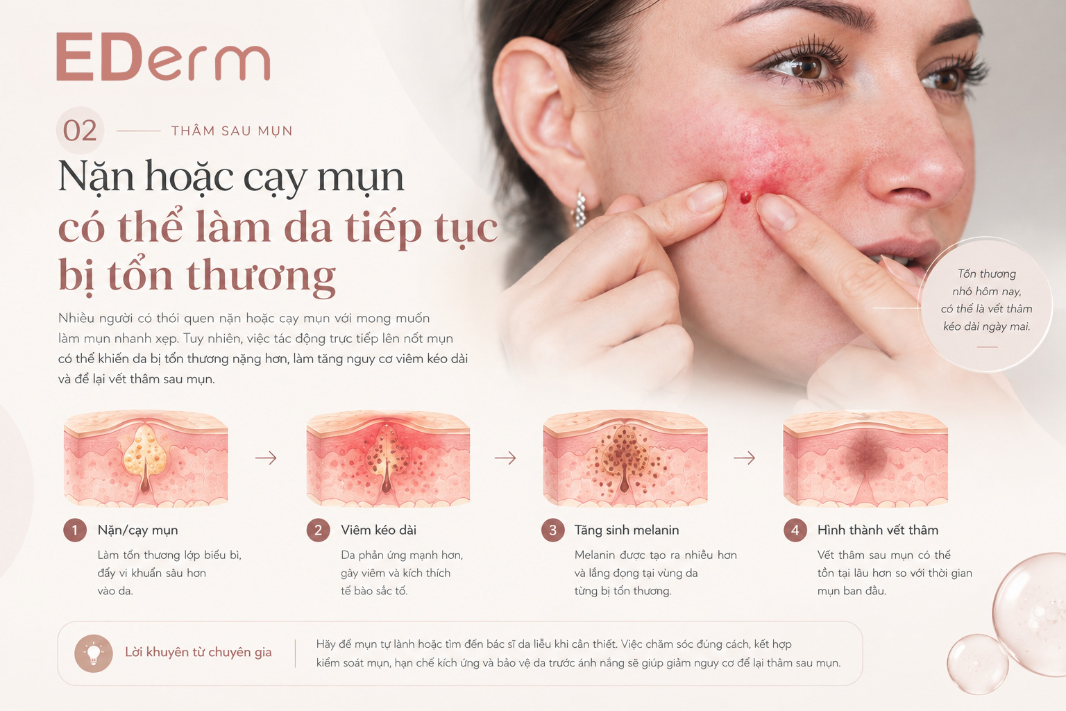 2. Nặn hoặc cạy mụn có thể làm da tiếp tục bị tổn thương