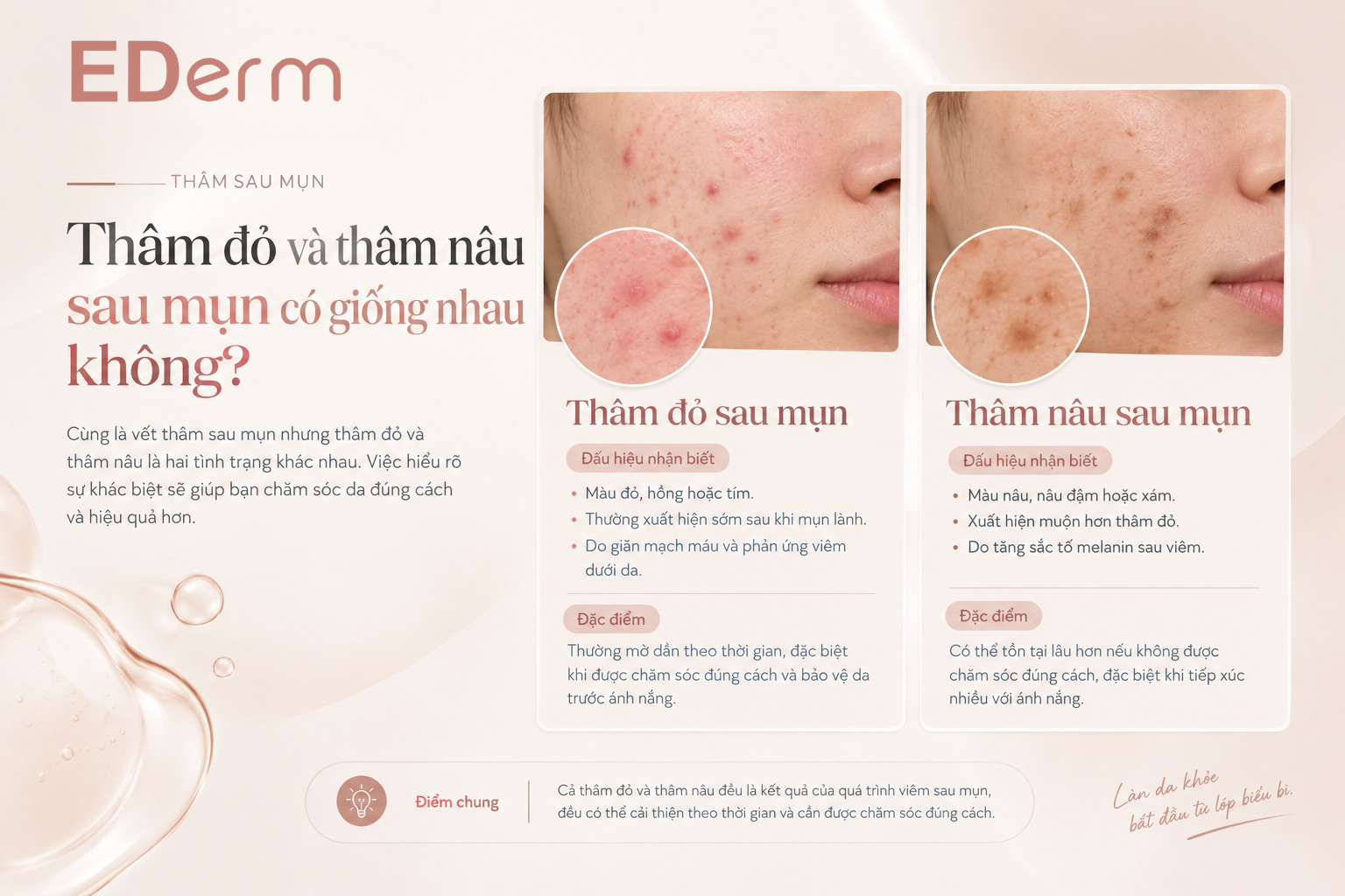 Thâm đỏ và thâm nâu sau mụn có giống nhau không