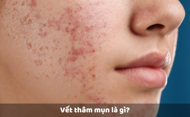 Thâm sau mụn là gì